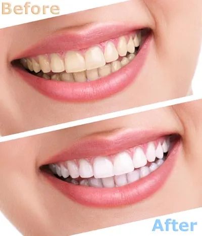 before and after look at opalescence teeth whitening provided by iSmile Orthodontics in San Ramon, CA